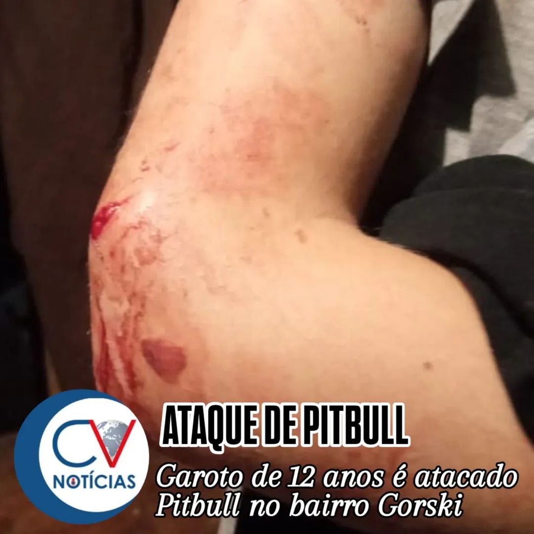 ​Garoto de 12 anos é atacado por pitbull no bairro Francisco Gorski em Campo Largo